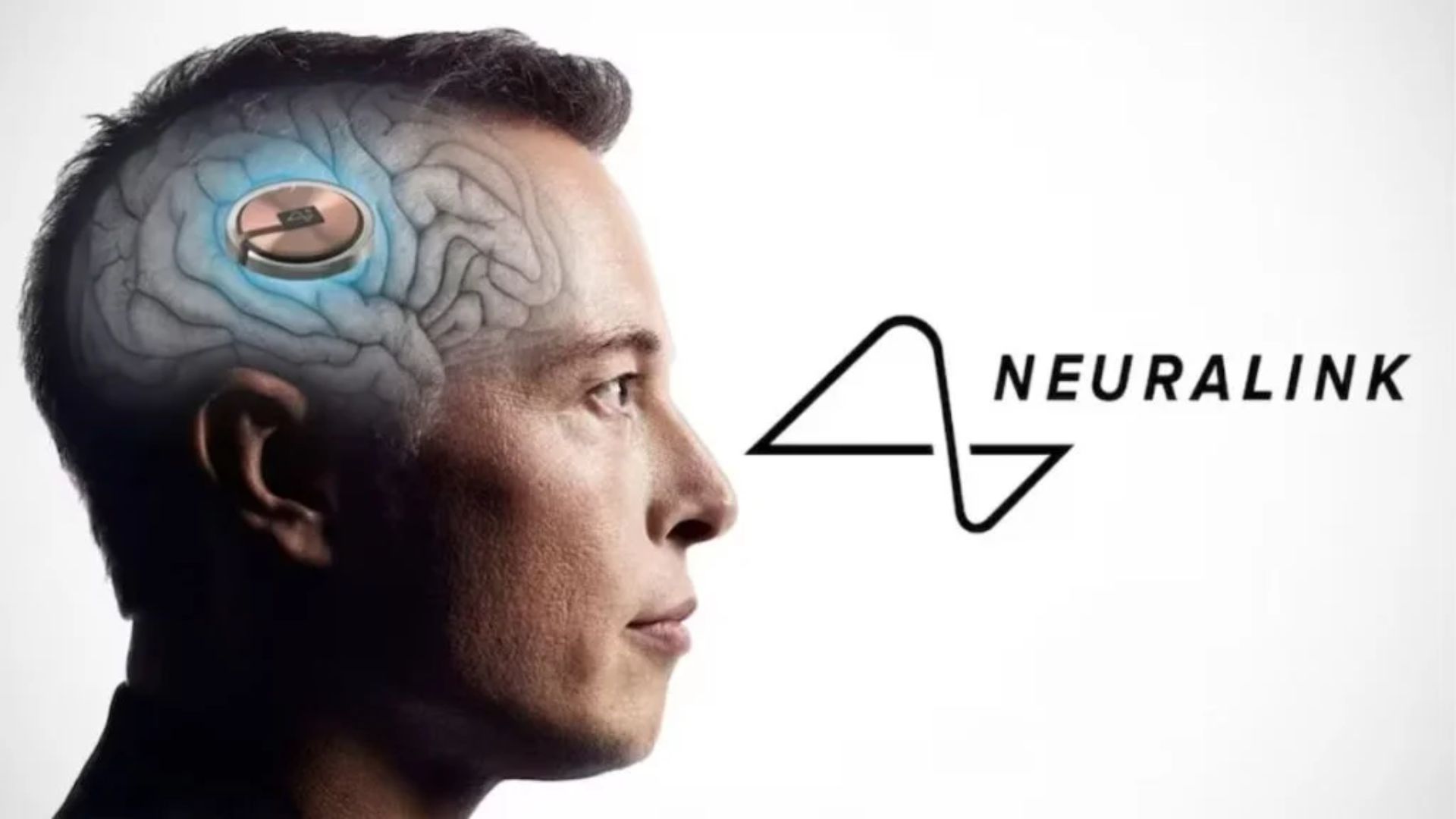 Neuralink Successfully Implants Brain Chip in Second Trial Patient, Says Musk