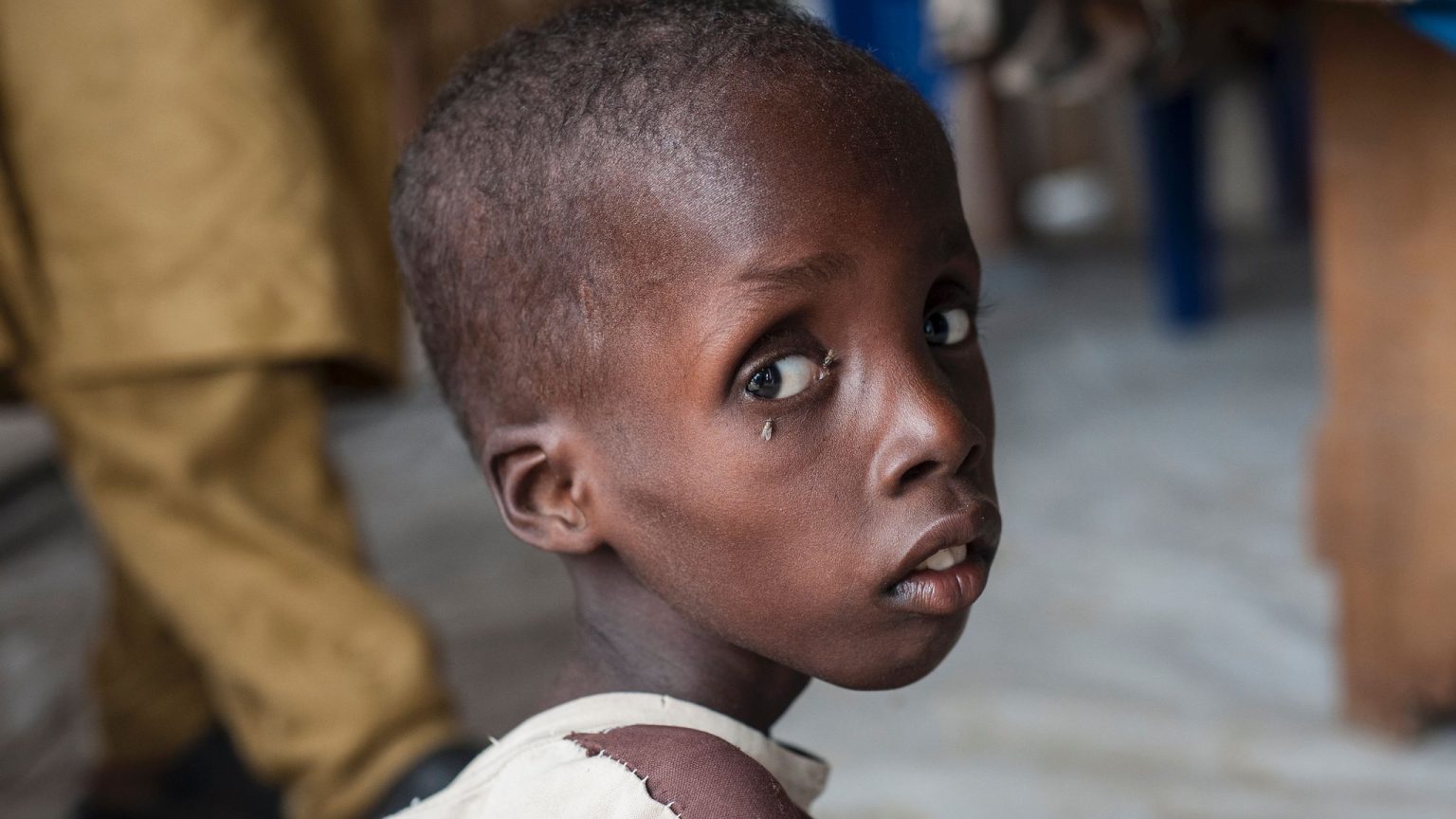 Malnutrition Responsible for 32% of Deaths in Children Under Five, Says FG